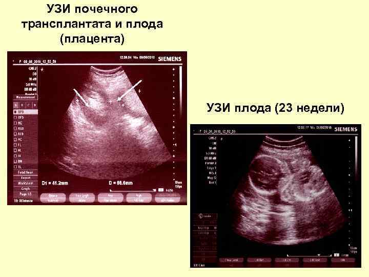 УЗИ почечного трансплантата и плода (плацента) УЗИ плода (23 недели) 