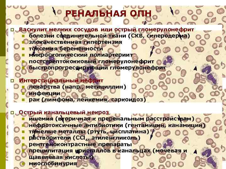 РЕНАЛЬНАЯ ОПН p Васкулит мелких сосудов или острый гломерулонефрит n болезни соединительной ткани (СКВ,