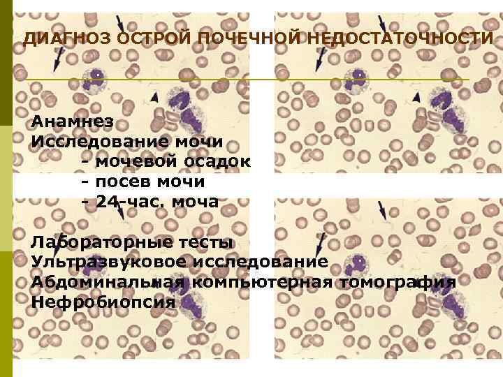 ДИАГНОЗ ОСТРОЙ ПОЧЕЧНОЙ НЕДОСТАТОЧНОСТИ Анамнез Исследование мочи - мочевой осадок - посев мочи -