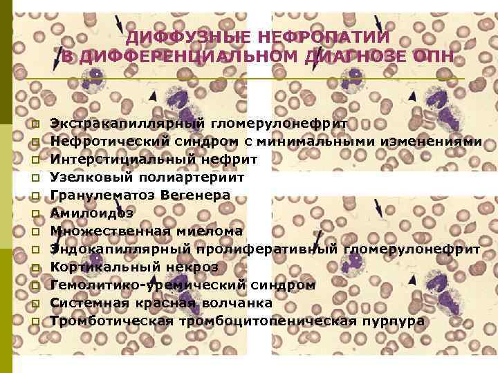 ДИФФУЗНЫЕ НЕФРОПАТИИ В ДИФФЕРЕНЦИАЛЬНОМ ДИАГНОЗЕ ОПН p p p Экстракапиллярный гломерулонефрит Нефротический синдром с