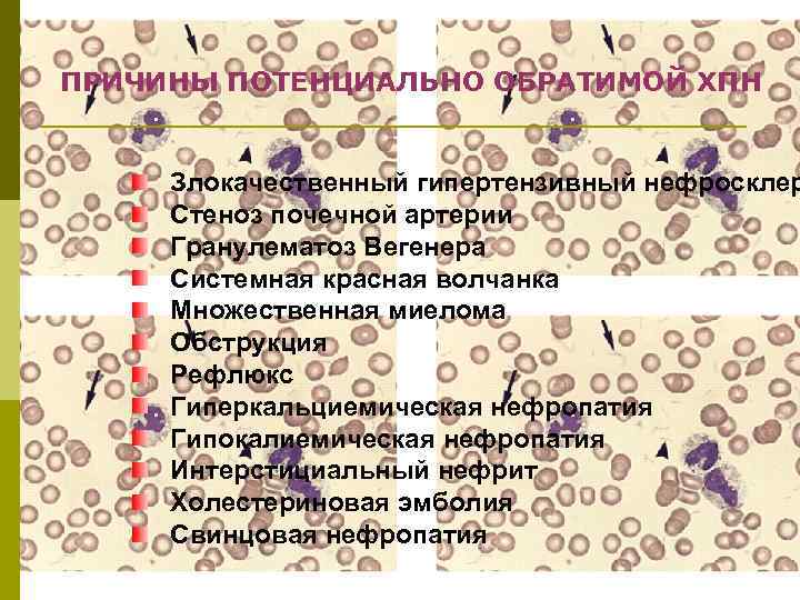 ПРИЧИНЫ ПОТЕНЦИАЛЬНО ОБРАТИМОЙ ХПН Злокачественный гипертензивный нефросклер Стеноз почечной артерии Гранулематоз Вегенера Системная красная