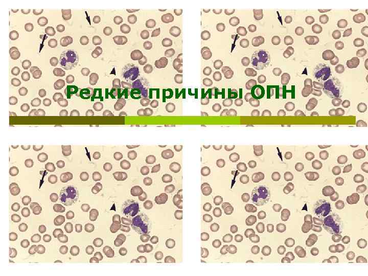 Редкие причины ОПН 