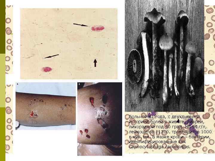 Больной 41 года, с двухдневной историей болей в животе, диареи, лихорадкой под 40 град.