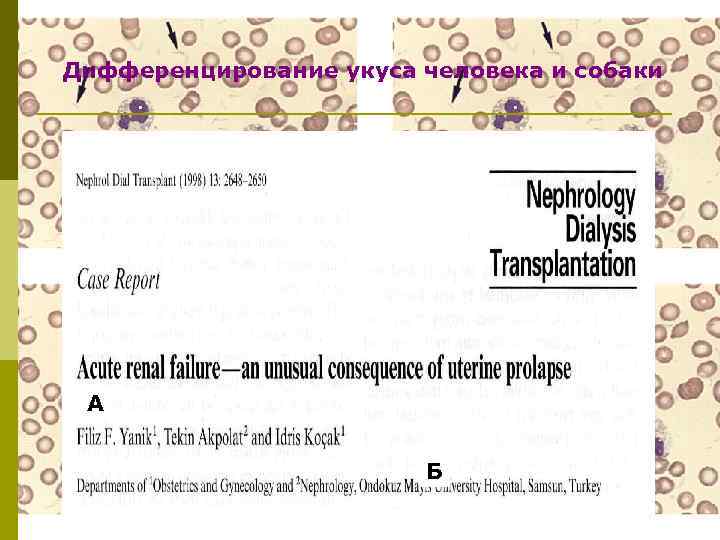 Дифференцирование укуса человека и собаки А Б 