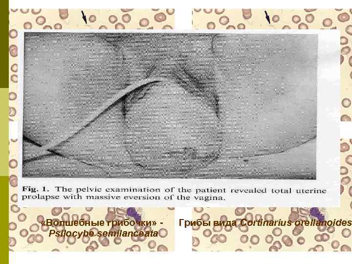  «Волшебные грибочки» Psilocybe semilanceata Грибы вида Cortinarius orellanoides 