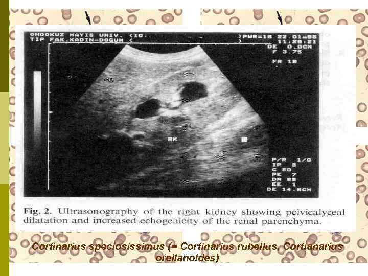 Cortinarius speciosissimus (= Cortinarius rubellus, Cortianarius orellanoides) 