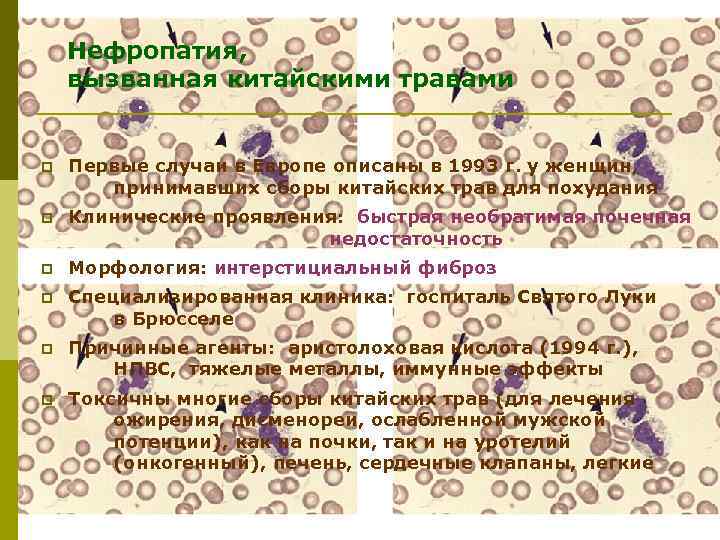Нефропатия, вызванная китайскими травами p Первые случаи в Европе описаны в 1993 г. у