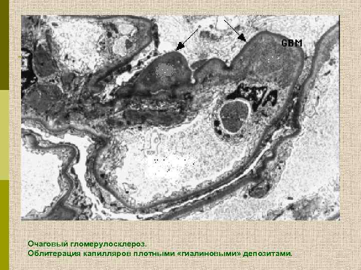 Очаговый гломерулосклероз. Облитерация капилляров плотными «гиалиновыми» депозитами. 