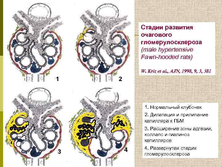 Стадии развития очагового гломерулосклероза (male hypertensive Fawn-hooded rats) W. Kriz et al. , AJN,
