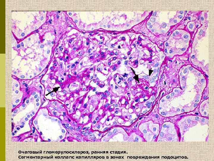 Очаговый гломерулосклероз, ранняя стадия. Сегментарный коллапс капилляров в зонах повреждения подоцитов. 