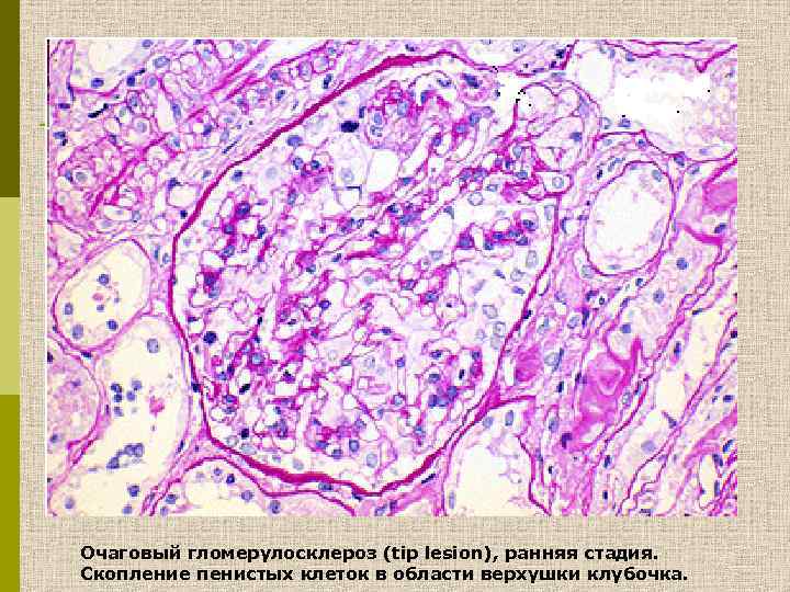 Очаговый гломерулосклероз (tip lesion), ранняя стадия. Скопление пенистых клеток в области верхушки клубочка. 
