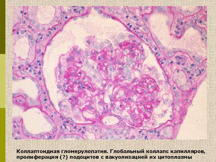 Коллаптоидная гломерулопатия. Глобальный коллапс капилляров, пролиферация (? ) подоцитов с вакуолизацией их цитоплазмы 