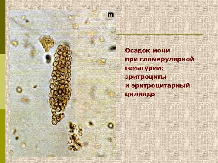 Осадок мочи при гломерулярной гематурии: эритроциты и эритроцитарный цилиндр 
