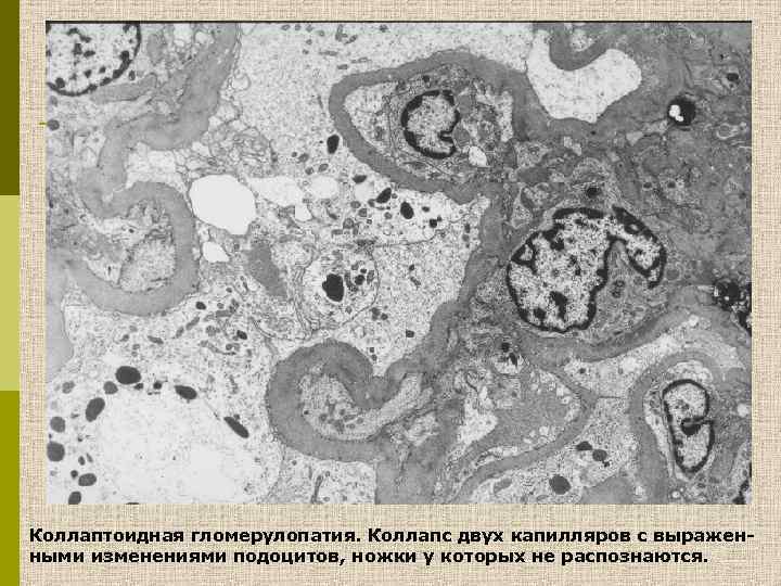 Коллаптоидная гломерулопатия. Коллапс двух капилляров с выраженными изменениями подоцитов, ножки у которых не распознаются.