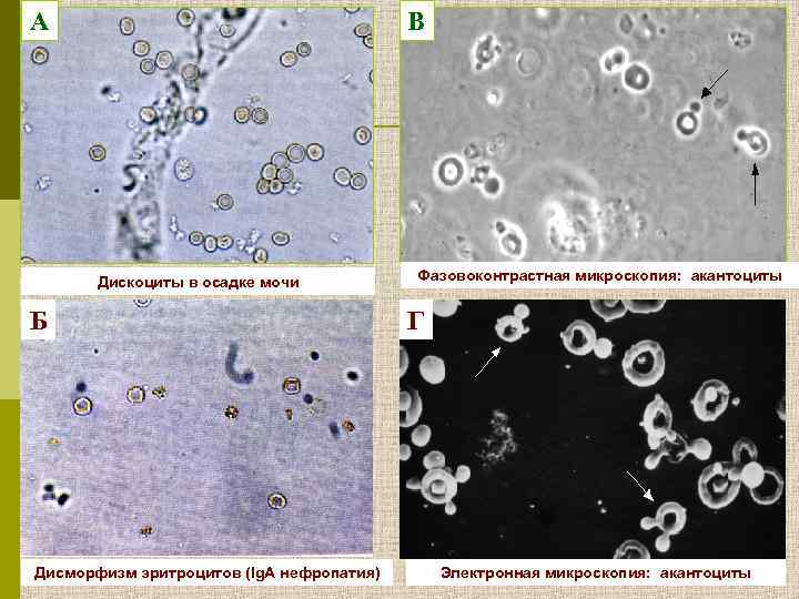А В Дискоциты в осадке мочи Б Дисморфизм эритроцитов (Ig. А нефропатия) Фазовоконтрастная микроскопия:
