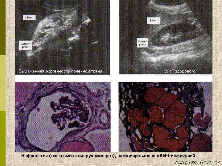 Выраженная эхогенность почечной ткани Эхо. Г здорового человека Нефропатия (очаговый гломерулосклероз), ассоциированная с ВИЧ-инфекцией