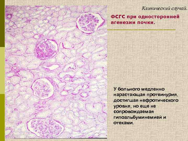 Клинический случай. ФСГС при односторонней агенезии почки. У больного медленно нарастающая протеинурия, достигшая нефротического