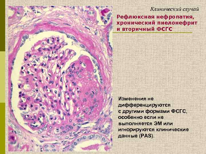 Клинический случай Рефлюксная нефропатия, хронический пиелонефрит и вторичный ФСГС Изменения не дифференцируются с другими