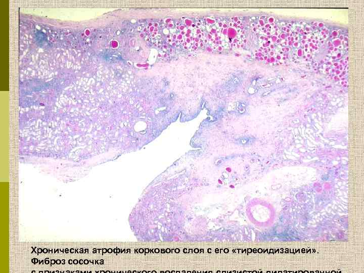 Хроническая атрофия коркового слоя с его «тиреоидизацией» . Фиброз сосочка 