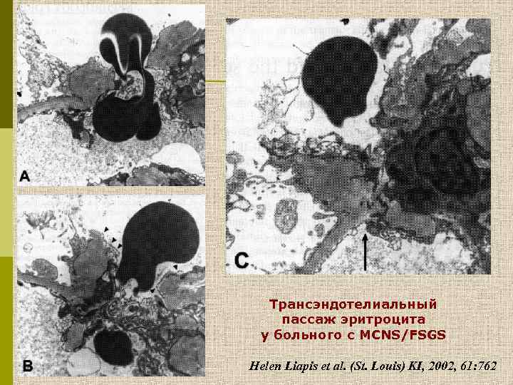 Трансэндотелиальный пассаж эритроцита у больного с МСNS/FSGS Helen Liapis et al. (St. Louis) KI,