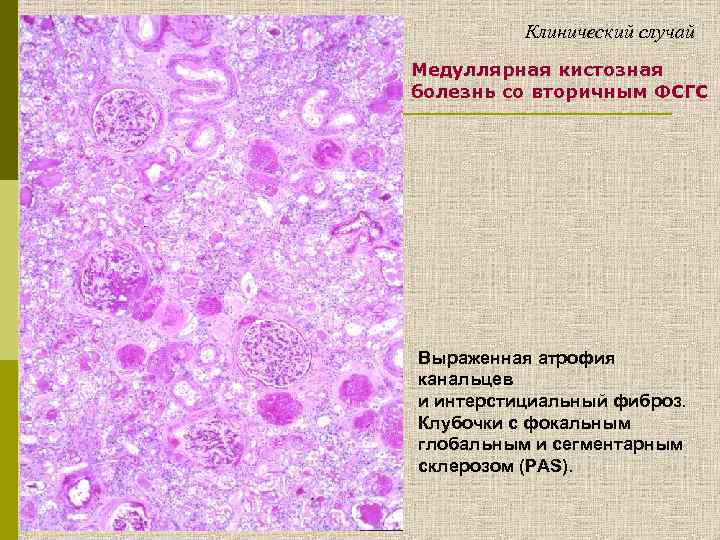 Клинический случай Медуллярная кистозная болезнь со вторичным ФСГС Выраженная атрофия канальцев и интерстициальный фиброз.