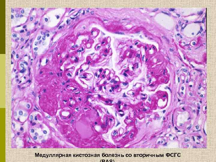 Медуллярная кистозная болезнь со вторичным ФСГС 