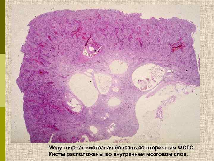 Медуллярная кистозная болезнь со вторичным ФСГС. Кисты расположены во внутреннем мозговом слое. 