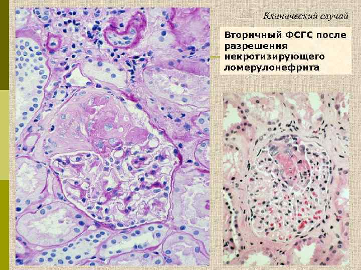 Клинический случай Вторичный ФСГС после разрешения некротизирующего ломерулонефрита 