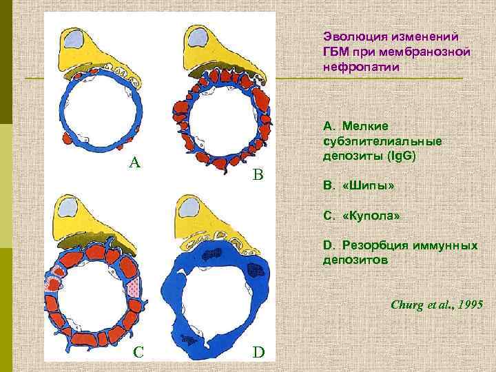 Эволюция изменений ГБМ при мембранозной нефропатии А А. Мелкие субэпителиальные депозиты (Ig. G) B