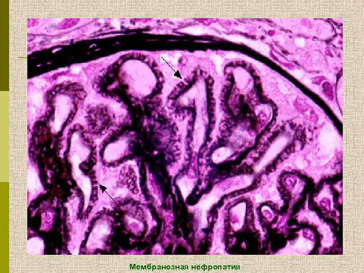 Мембранозная нефропатия 