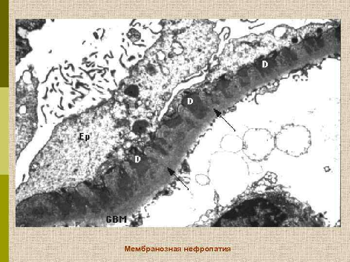 Мембранозная нефропатия 