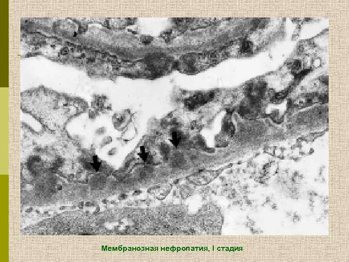 Мембранозная нефропатия, I стадия 