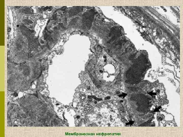 Мембранозная нефропатия 