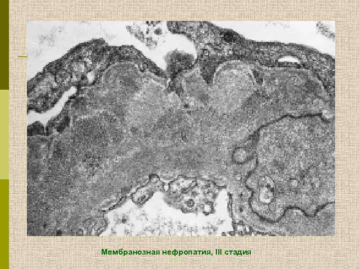 Мембранозная нефропатия, III стадия 