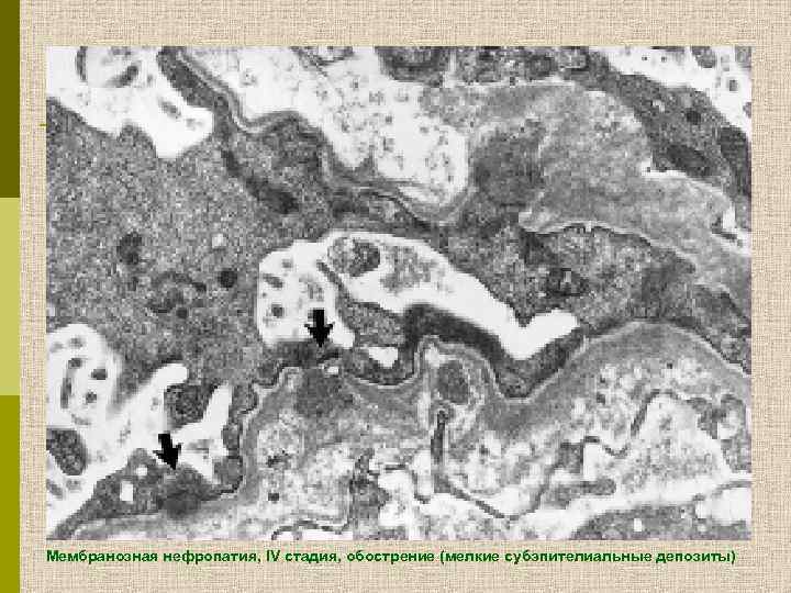 Мембранозная нефропатия, IV стадия, обострение (мелкие субэпителиальные депозиты) 