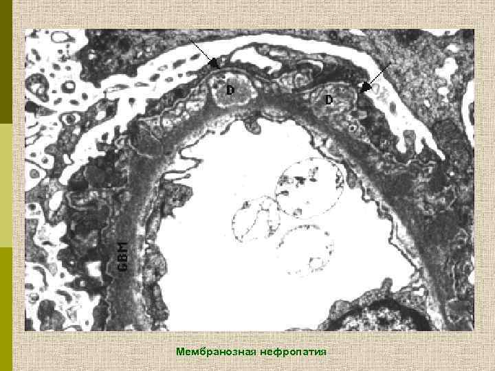 Мембранозная нефропатия 