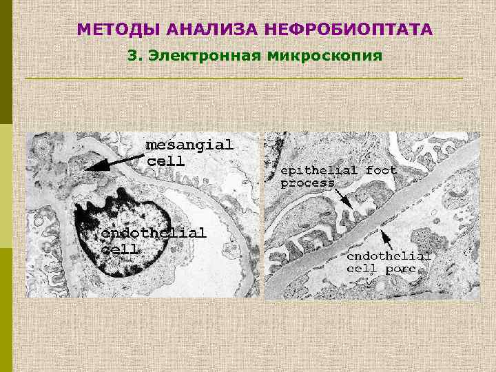 МЕТОДЫ АНАЛИЗА НЕФРОБИОПТАТА 3. Электронная микроскопия 
