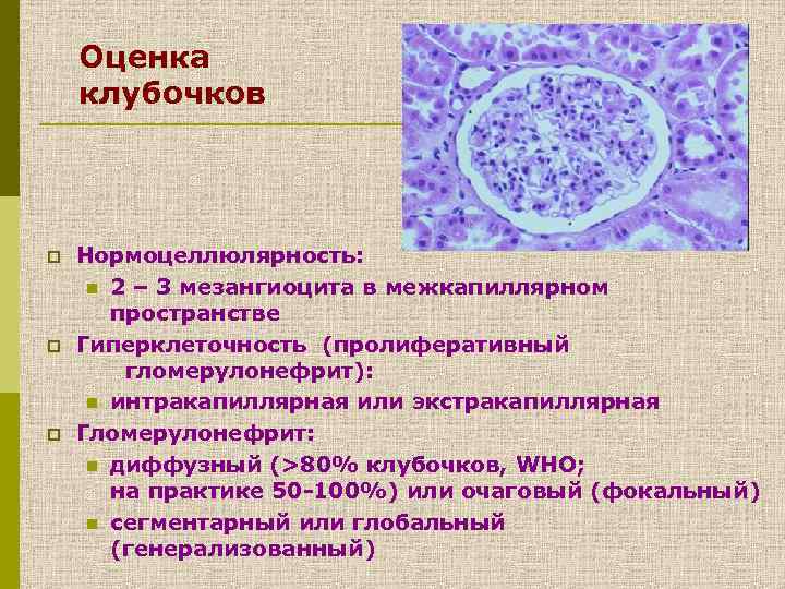Оценка клубочков p p p Нормоцеллюлярность: n 2 – 3 мезангиоцита в межкапиллярном пространстве