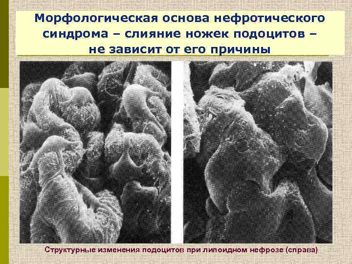 Морфологическая основа нефротического синдрома – слияние ножек подоцитов – не зависит от его причины