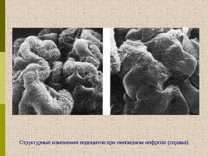 Структурные изменения подоцитов при липоидном нефрозе (справа) 