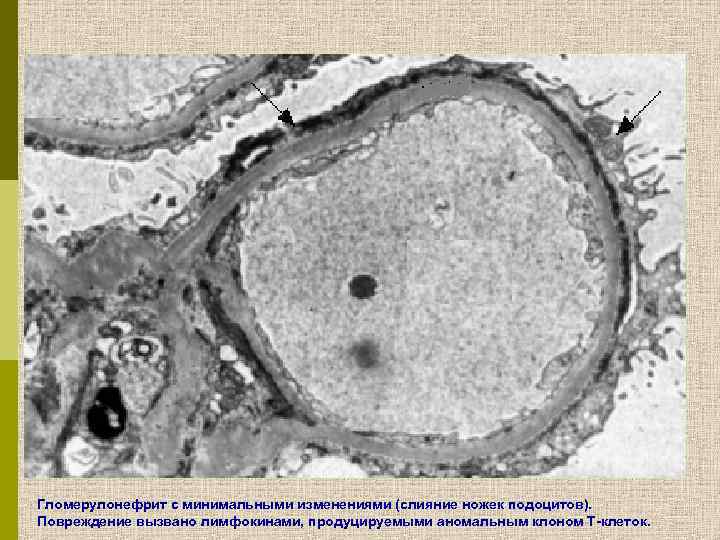 Гломерулонефрит с минимальными изменениями (слияние ножек подоцитов). Повреждение вызвано лимфокинами, продуцируемыми аномальным клоном Т-клеток.