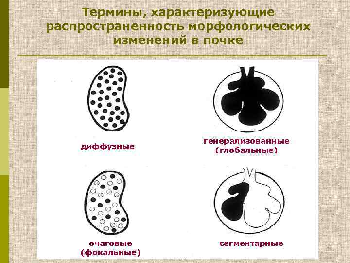 Термины, характеризующие распространенность морфологических изменений в почке диффузные очаговые (фокальные) генерализованные (глобальные) сегментарные 