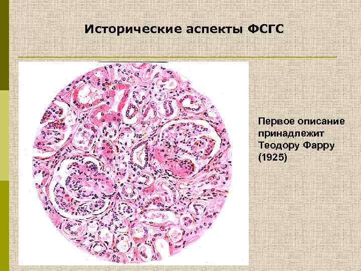 Исторические аспекты ФСГС Первое описание принадлежит Теодору Фарру (1925) 