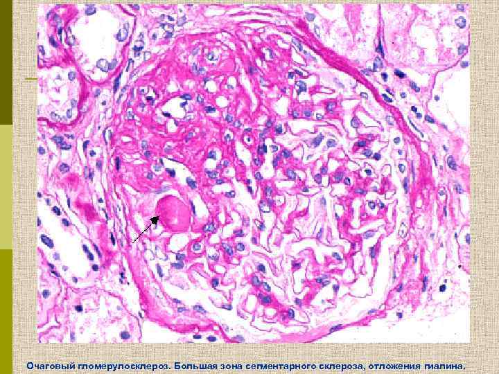Очаговый гломерулосклероз. Большая зона сегментарного склероза, отложения гиалина. 