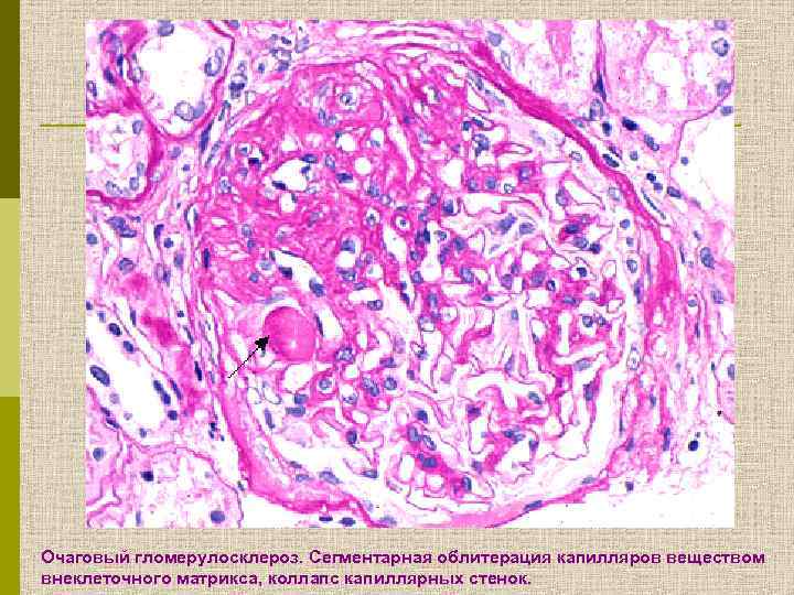 Очаговый гломерулосклероз. Сегментарная облитерация капилляров веществом внеклеточного матрикса, коллапс капиллярных стенок. 