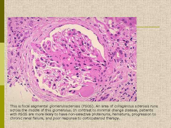 This is focal segmental glomerulosclerosis (FSGS). An area of collagenous sclerosis runs across the