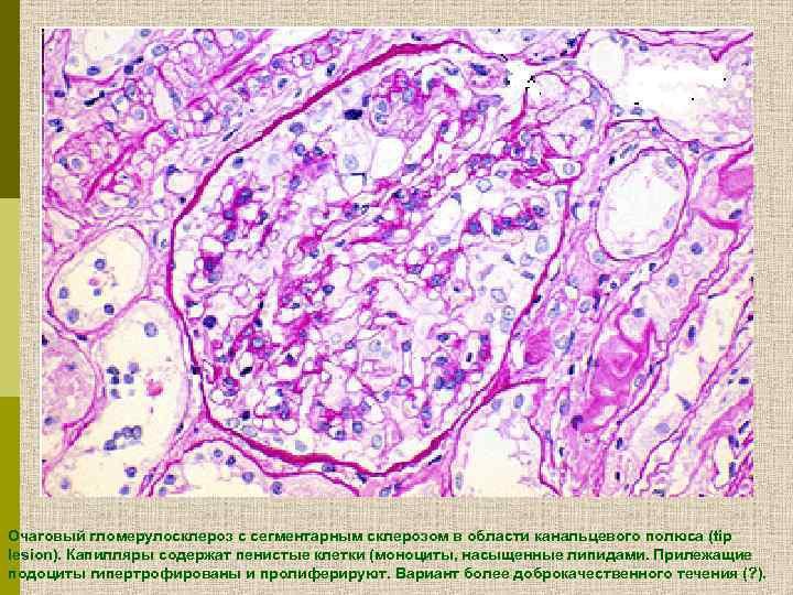 Очаговый гломерулосклероз c сегментарным склерозом в области канальцевого полюса (tip lesion). Капилляры содержат пенистые