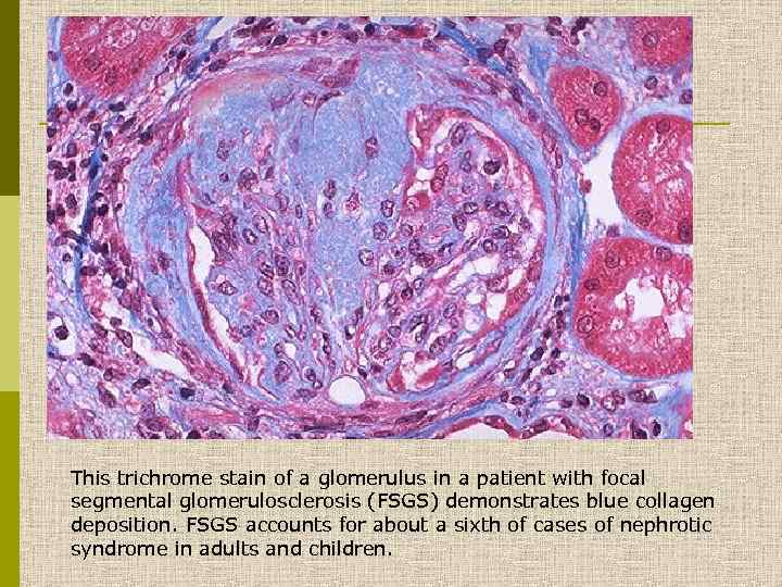 This trichrome stain of a glomerulus in a patient with focal segmental glomerulosclerosis (FSGS)