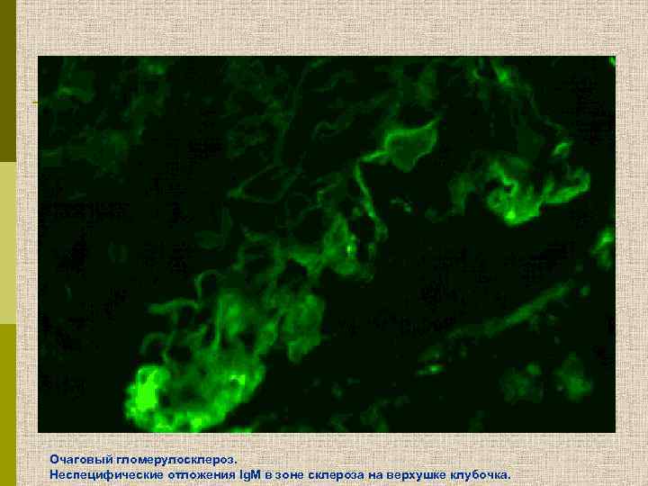 Очаговый гломерулосклероз. Неспецифические отложения Ig. М в зоне склероза на верхушке клубочка. 