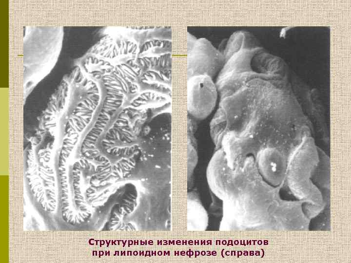 Структурные изменения подоцитов при липоидном нефрозе (справа) 